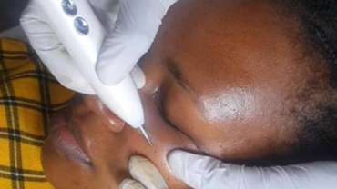DPN & Skin Tag Removal Therapy